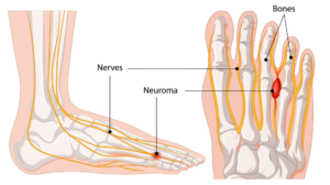 Matatarsalgia di Morton, dolore avampiede, Neuroma di Morton