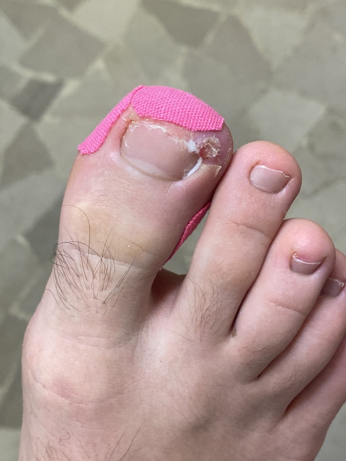 Podologo che cura un'unghia strappata, applicando un trattamento professionale.