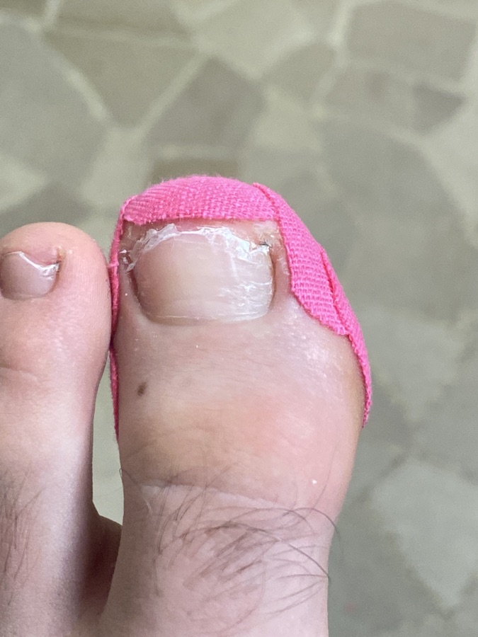Podologo che applica una medicazione su un'unghia strappata per favorire la guarigione.