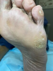 Callosità plantare sotto il piede, con pelle ispessita e giallastra nella zona metatarsale