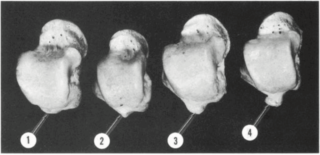 tubercolo postero-laterale astragalo