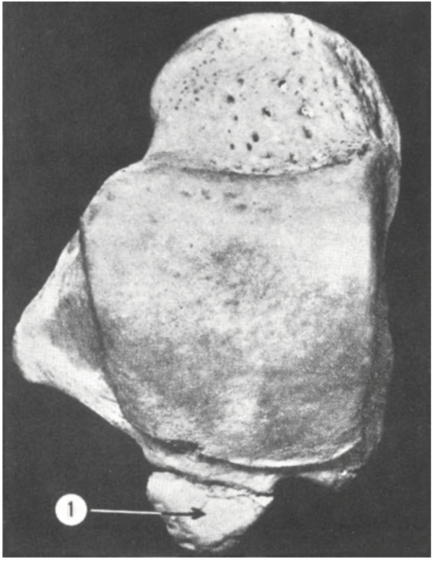 Os trigonum dell'astragalo